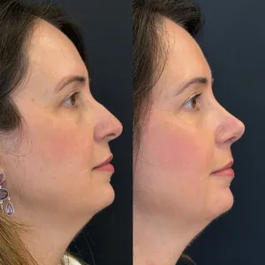 Comparação de perfil nasal antes e depois de rinoplastia, paciente da Dra. Érica Cauduro