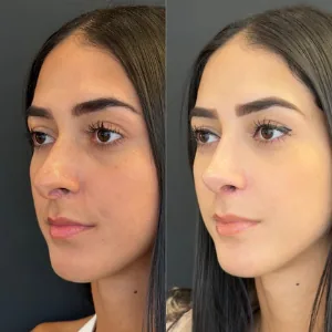 Comparação de perfil nasal antes e depois de rinoplastia, paciente da Dra. Érica Cauduro