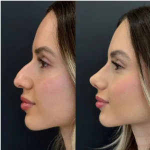 Comparação de perfil nasal antes e depois de rinoplastia, paciente da Dra. Érica Cauduro