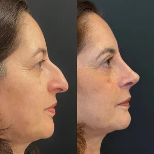 Comparação de perfil nasal antes e depois de rinoplastia, paciente da Dra. Érica Cauduro